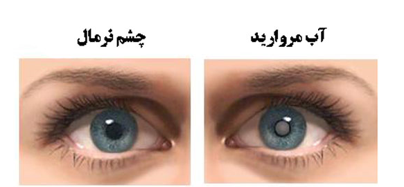 كاتاراكت(آب مرواريد)