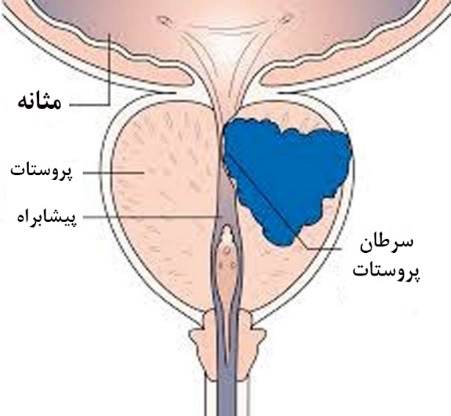 سرطان پروستات