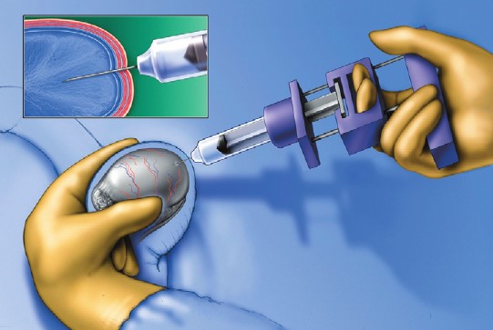 توصيه هاي بعد از عمل استخراج اسپرم ازبيضه