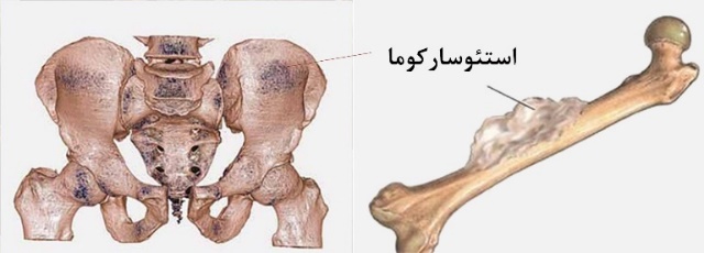 استئو ساركوما