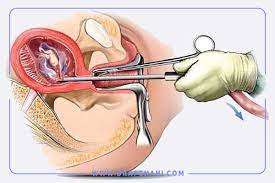 خودمراقبتي كورتاژ تشخيصي