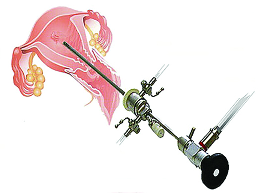 هيستروسكوپي(مشاهده رحم ازطريق آندوسكوپ)