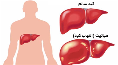 هپاتيت