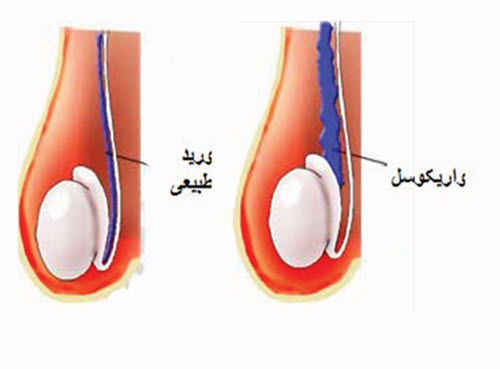 واريكوسل