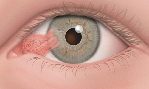 ناخنك(تريژيوم)